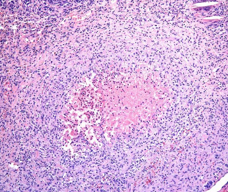 Central camedo type tumor necrosis is