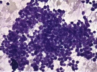 Small Cell Neuroendocrine Carcinoma Round, oval or spindle cells