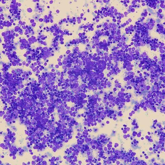 Cytologic Features of LCNEC Tissue fragments