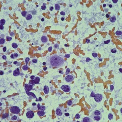 Cytologic Features of LCNEC Moderate amount of cytoplasm Round to oval nuclei with