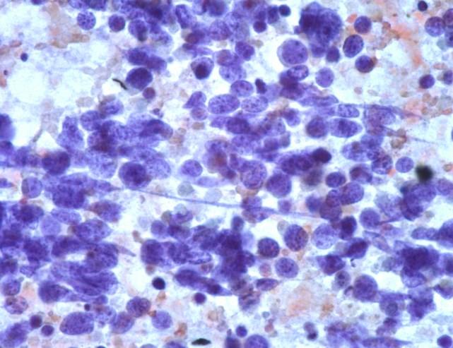 Cytologic Features of LCNEC Nuclear molding Naked