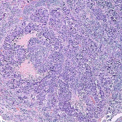 Histologic Features of LCNEC Large confluent organoid nests of tumor