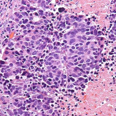 Histologic Features of LCNEC Individual tumor cells are large with moderate cytoplasm Nuclei have large nucleoli Mitotic