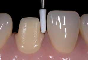 The following factors influence the integration of the restoration in terms of its shade: Shade of the prepared tooth Shade, translucency and thickness of the restoration Indication and material The