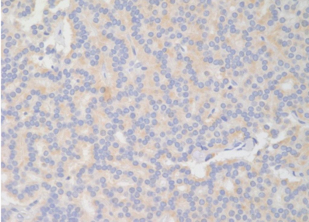 278 Young Eun Kim Jeeyun Lee Young Suk Park, et al. RESULTS Positive immunostaining for SSTR2A was found in 67 of 69 (97%) NET G1, and 1 of 6 (17%) NET G2 (Table 2).