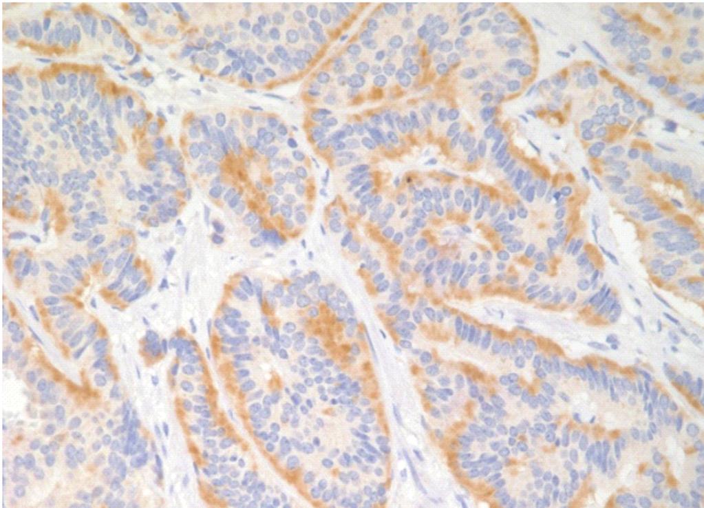 In cases scoring 1+ (n=8), the staining was relatively non-specific with diffuse cytoplasmic localization.