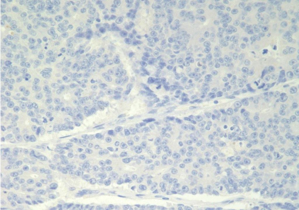 Results of immunohistochemistry for somatostatin receptor type 2A in the neuroendocrine neoplasms of the colorectum WHO 2010 classification NET G1 NET G2 NEC Staining intensity Negative Positive 0 1+