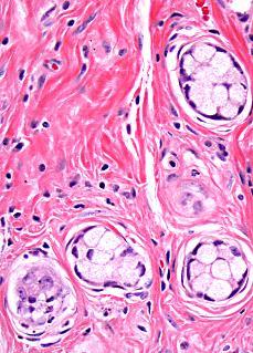 Classical Goblet cell carcinoid Is it really a carcinoid?