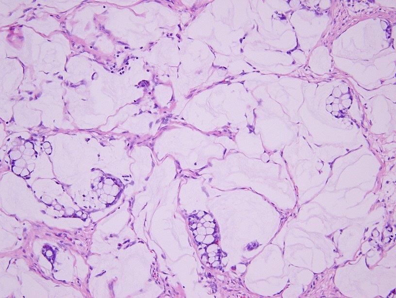 Distinctive features of adenoca ex GCC (appendiceal crypt cell adenocarcinoma) allow it to be recognized as an appendiceal primary even in metastatic