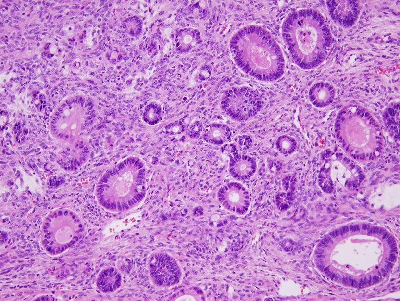 Small round glands resembling crypts, even if without