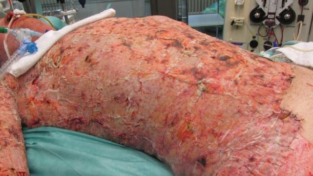 Operations Day 16: Epifascial necrectomy neck, groin region on the right, covering with 1:1 split-thickness skin graft Day 22: Tangential debridement back, shoulders on both sides, thorax, axillae on