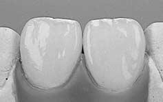 Subsequently complete the build up with Opal Incisal and expand the interproximal areas slightly oversized after removing the crown.