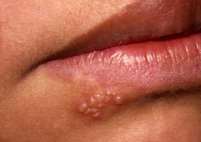HERPES Blister-like lesions appear on skin, genitals, eye, mouth, any other mucosal surface Usually contracted from an infected person, by direct contact Both chicken pox & shingles are herpes, & are