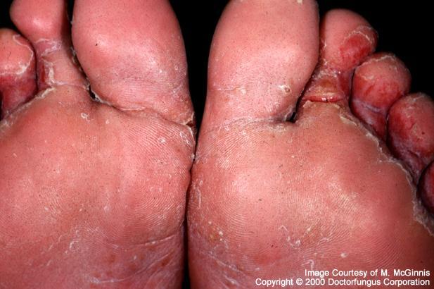 Some Common SUPERFICIAL Fungal Infections