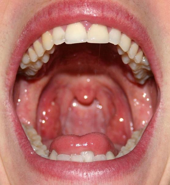 oropharynx, vestibule, and the lingual & buccal surfaces of