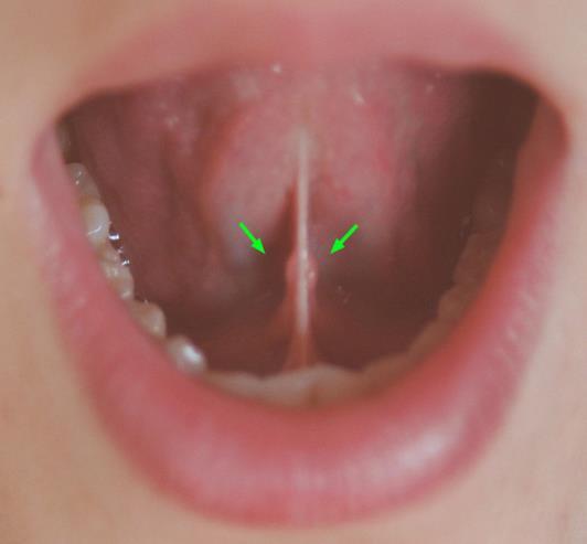 ID the Lingual frenulum and openings of the ducts of the