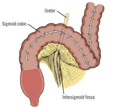 Peritoneal Fossae / Recesses Intersigmoid recess Meso-sigmoid attached to posterior abdominal wall in relation to where