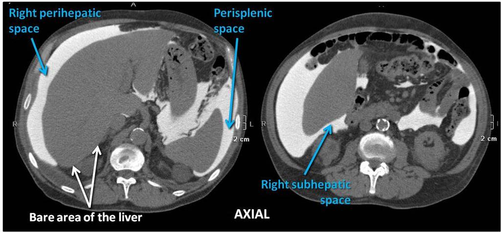 Fig. 5: CT Peritoneography. Axial view. Right and left perihepatic spaces, separated by the falciform ligament, and the perisplenic space. Sto-Stomach, Liv-Liver, Spl-Spleen. Fig.