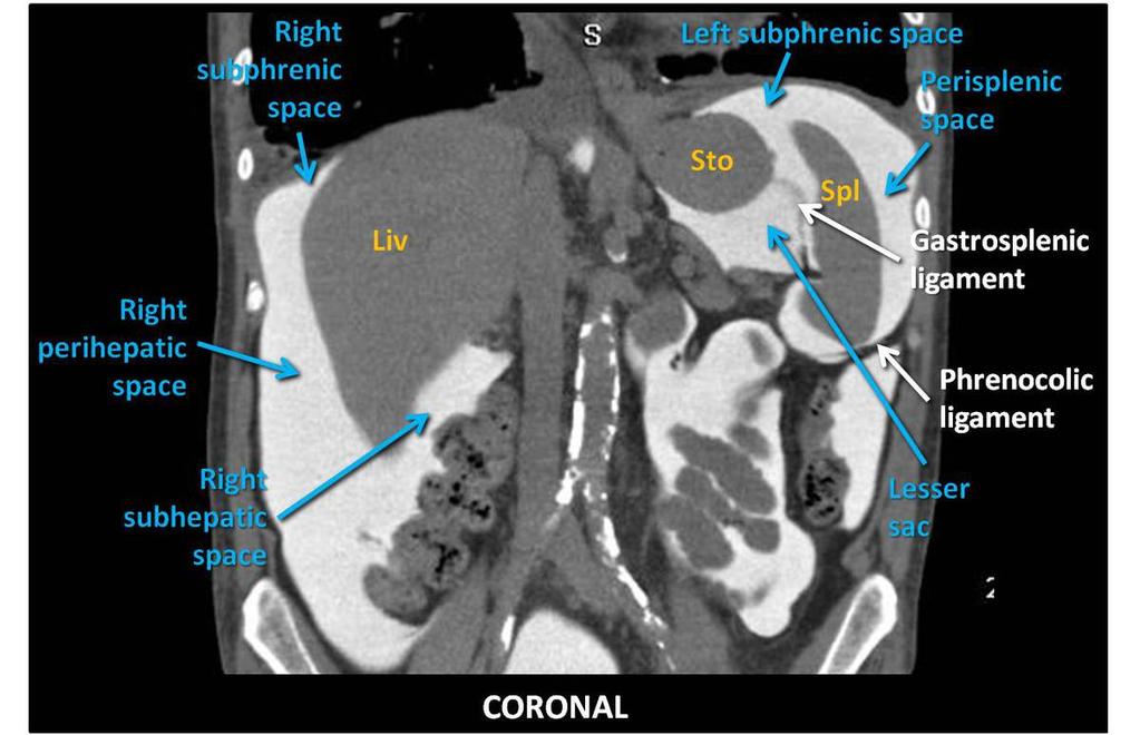 Fig. 7: CT Peritoneography. Sagital view. The bare area of the liver is devoid of peritoneum. This bare area is continuous with the right anterior pararenal space. LivLiver, RKid-Right Kidney. Fig.