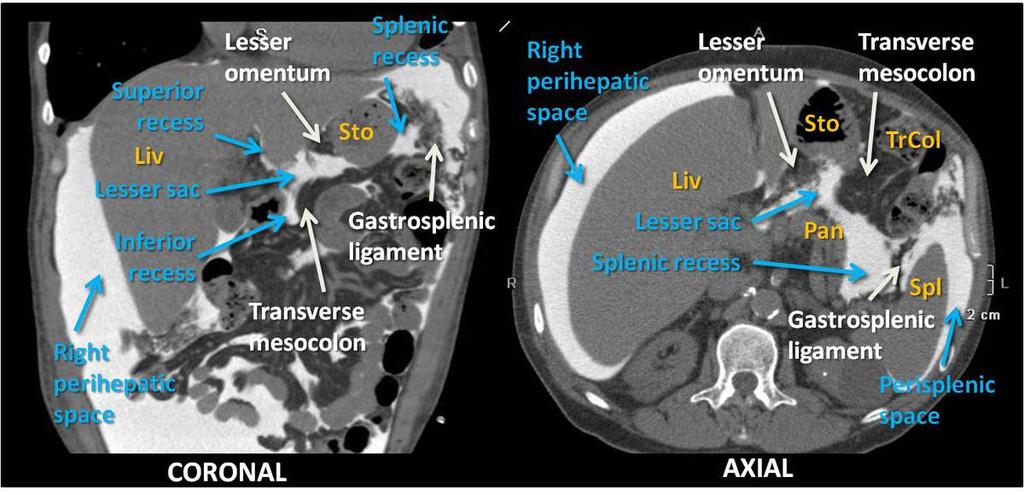 Fig. 9: CT Peritoneography. Coronal and axial views. Lesser sac.