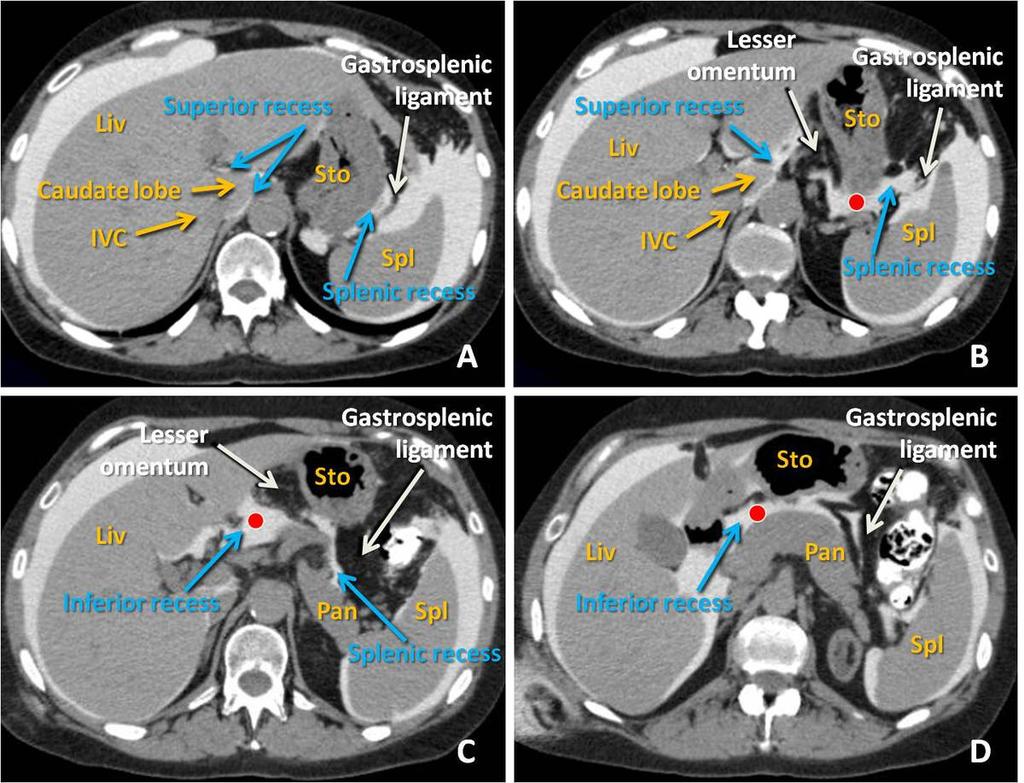 Fig. 11: CT Peritoneography. Axial views from craneal (A) to caudal (D). Lesser sac (red dot). The superior recess surrounds the medial aspect of the caudate lobe.