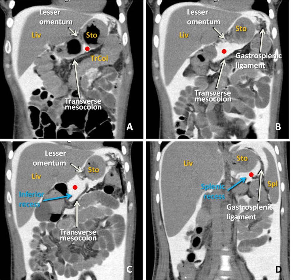 Fig. 12: CT Peritoneography. Coronal views from anterior(a) to posterior (D). Lesser sac (red dot).