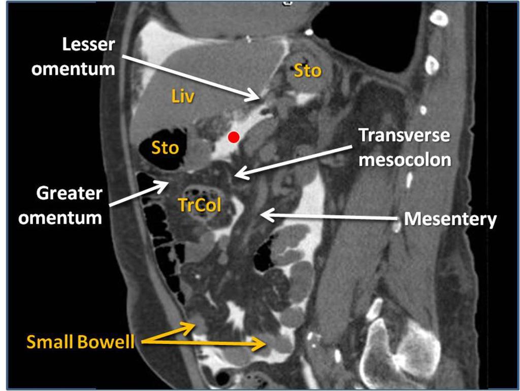 Fig. 10: CT Peritoneography. Sagital view. Lesser sac (red dot).