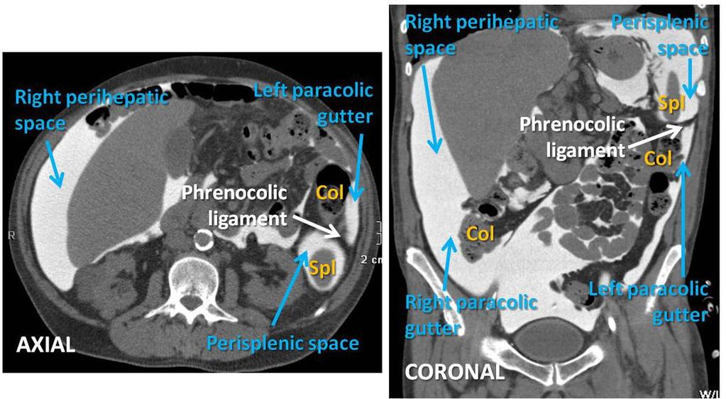 Fig. 15: CT Peritoneography. Axial and coronal views.