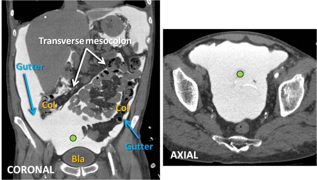 Fig. 16: CT Peritoneography. Axial and coronal views. The abdominal central space (blue dot) is located caudal to the transverse mesocolon and between ascending and descending colon.