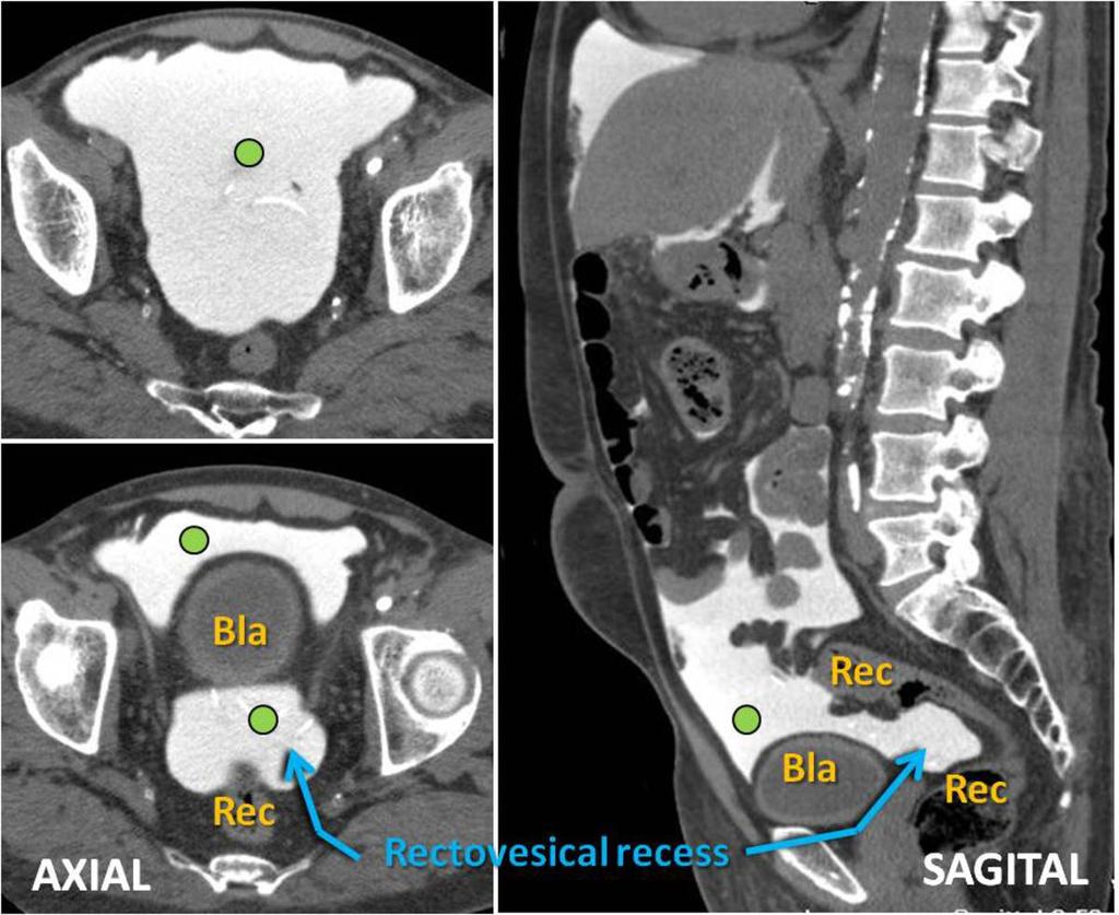Fig. 18: CT Peritoneography. Axial and coronal views. Pelvic space (green dot).
