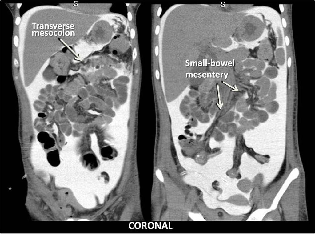 Abdominal central space: it is located caudal to the transverse mesocolon and between ascending and descending colon.it contains the small bowel and communicates with the pelvic space. Fig.