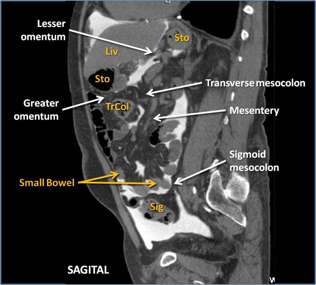 Fig. 2: CT Peritoneography. Sagital view. Transverse mesocolon, small bowel mesentery and sigmoid mesocolon.