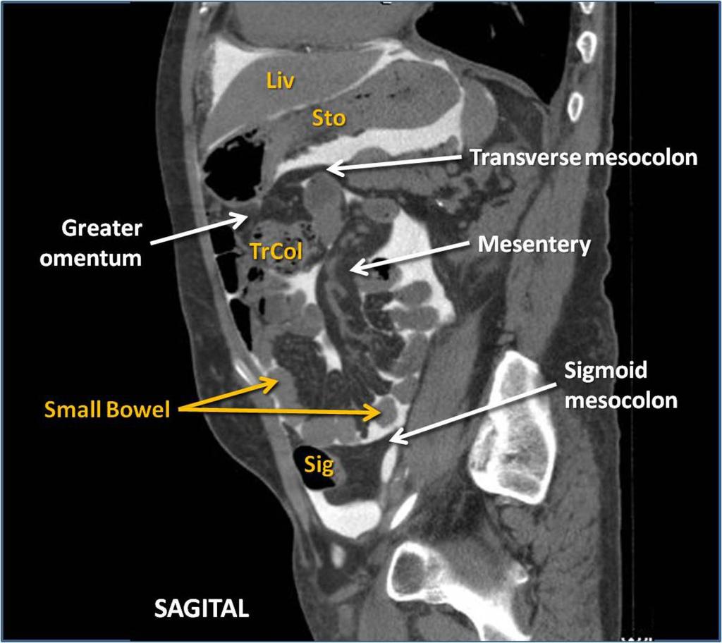 Fig. 3: CT Peritoneography. Sagital view. Transverse mesocolon, small bowel mesentery and sigmoid mesocolon.