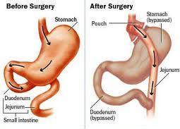 GASTRIC BYPASS SURGERY