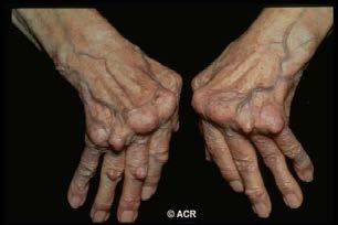 se Rheumatoid arthritis (RA) A chronic articular and systemic