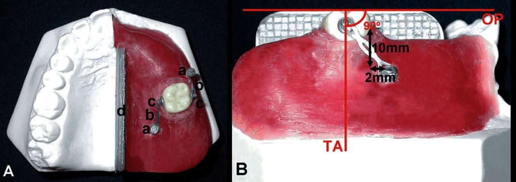 Med Oral Patol Oral Cir Bucal. 21 Nov 1;15 (6):e93-5. Fig. 1. Digital photographs of the models used. A, Occlusal view.
