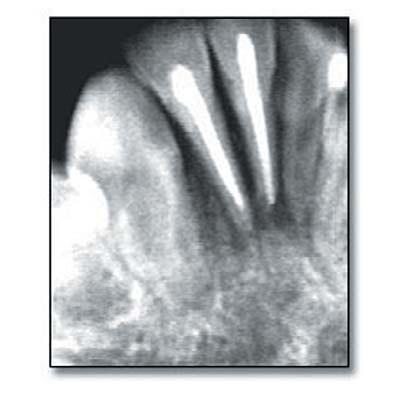 Figure 6. Periapical image after 30 days.