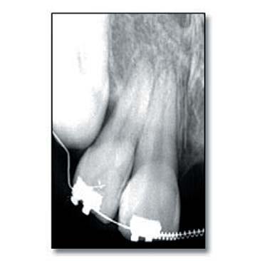 Periapical image after one year.