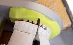 Then the single teeth are fixed with Utility Wax onto the caped articulator plaster model and the modification of the