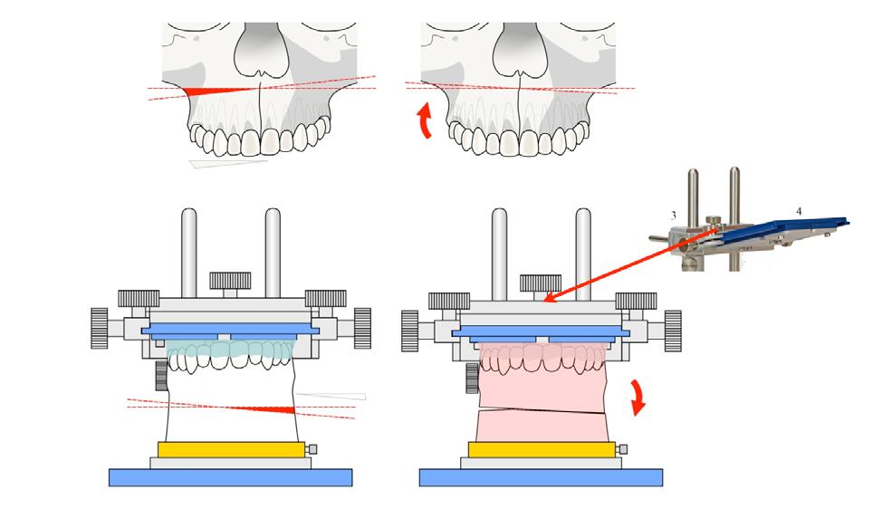 To bring the maxilla down, turning the screw shown in green and vertically displacing the maxilla by the planned number of millimeters is sufficient (Figure 8).