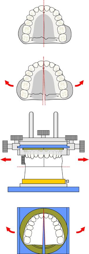 The lower model is transferred to the SMAD, a silicone impression of the teeth is taken, the base of the model is sectioned, and the segment is moved forward by the planned number of millimeters