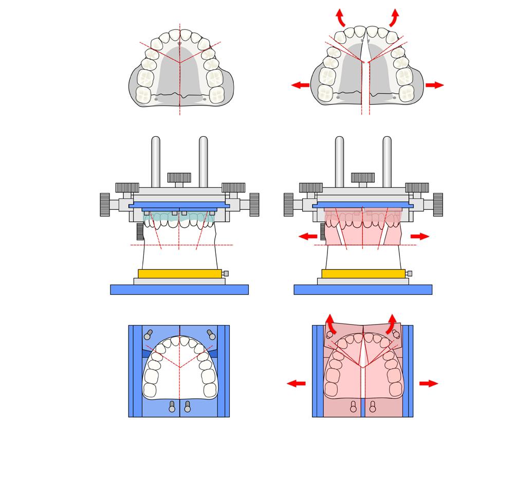 (Figure 12) Le Fort I Segmental in four pieces: Following this exact procedure, the SMAD plate allows the independent movement of up to four segments of the maxilla, as can be seen in Figure 13.