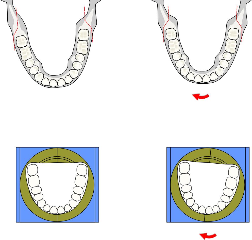 Mandibular Sagittal Splint Canting - Levelling: (Figure 17) Figure 19 shows the frontal plane mandibular rotation for leveling of the lower occlusal plane as well as the mandibular edges.