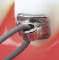 Each Slim-case includes: Orthodontic Tooth Brush Interproximal Brush Travel