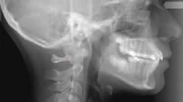 Magnetic force systems in orthodontics. Am J Orthod 1985;87:201-10. 11. Gianelly AA, Vaitas AS, Thomas WM. The use of magnets to move molars distally. Am J Orthod Dentofacial Orthop 1989;96:161-7. 12.