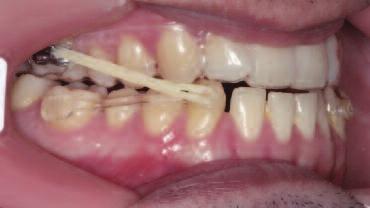 Gianelly A, Bednar J, Dietz V. Japanese NiTi coils used to move molars distaly. Am J Orthod Dentofacial Orthop 1991;99:564-6. 16. Gianelly A. Distal movement of the maxillary molars.