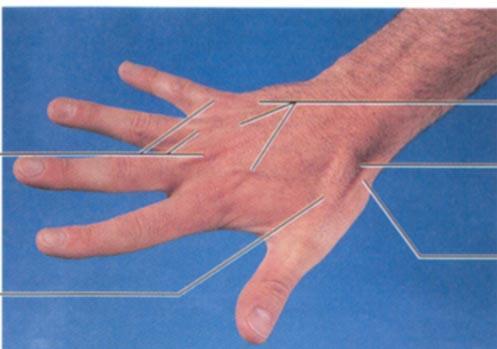 Surface Anatomy of Upper Limb Carpal Tunnel Carpals concave anteriorly Carpal ligament covers it Contains: long tendons, Median nerve Inflammation of tendons = compression of