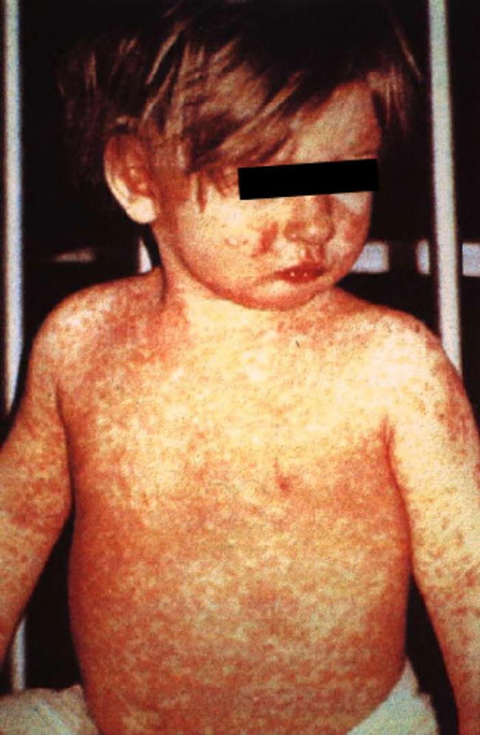 Background Measles is a highly contagious, viral disease characterized by fever, cough, coryza, conjunctivitis, and a maculopapular rash.