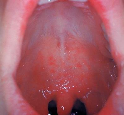 Clinical Features Koplik Spots Small white spots present on mucous membranes and occur 2-3 days after symptoms