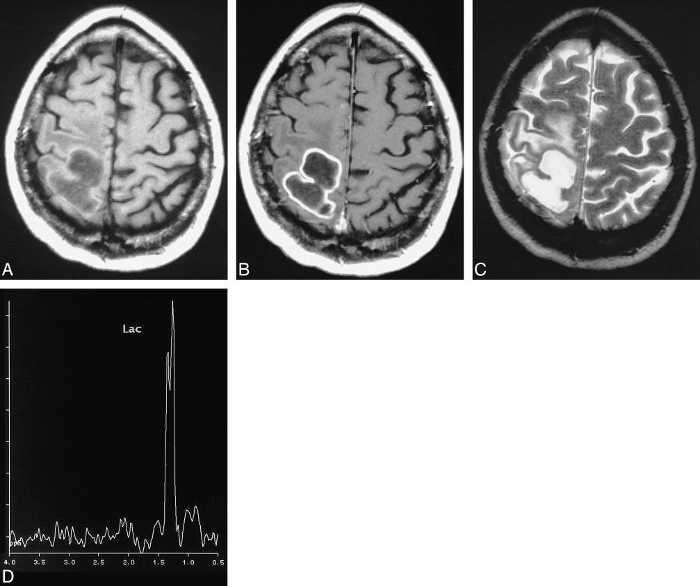 1050 BURTSCHER AJNR: 20, June/July 1999 FIG 1. MR images of patient 1 with a brain abscess.
